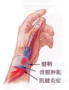 右手大拇指疼的不能弯曲?赵治伟:玩手机玩出了