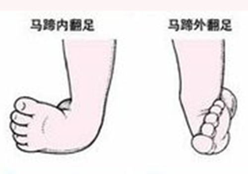 马蹄内翻足超90%可治愈 李东升:外固定矫形技术让长歪